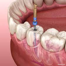 emergency root canal