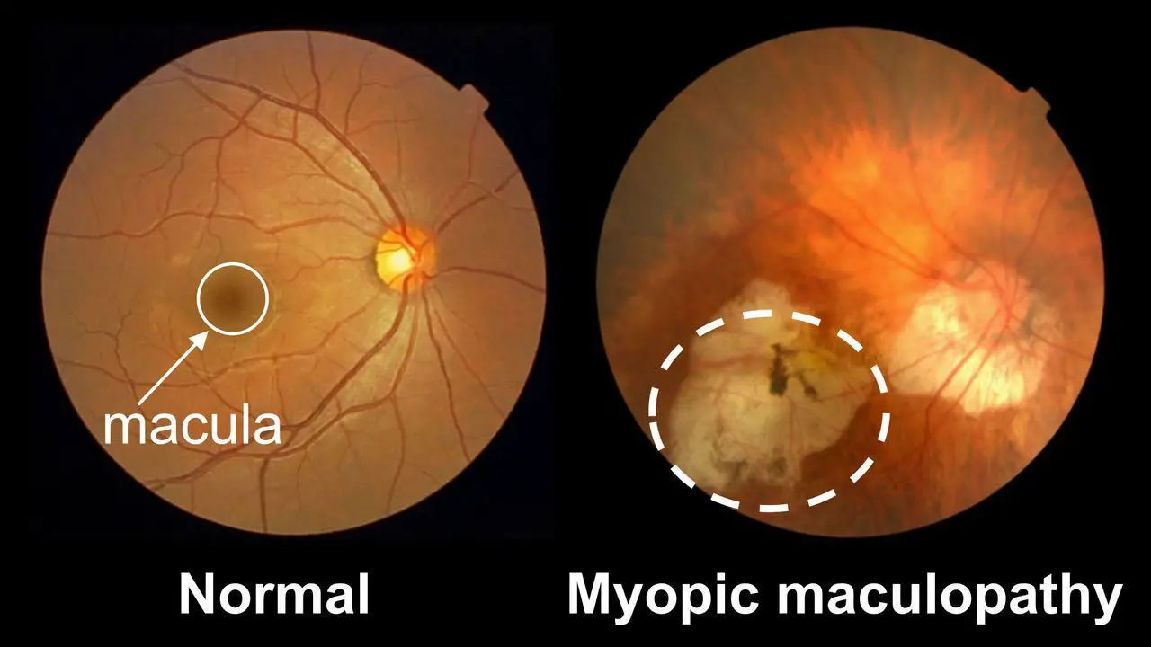 Maculopathy screenshot 