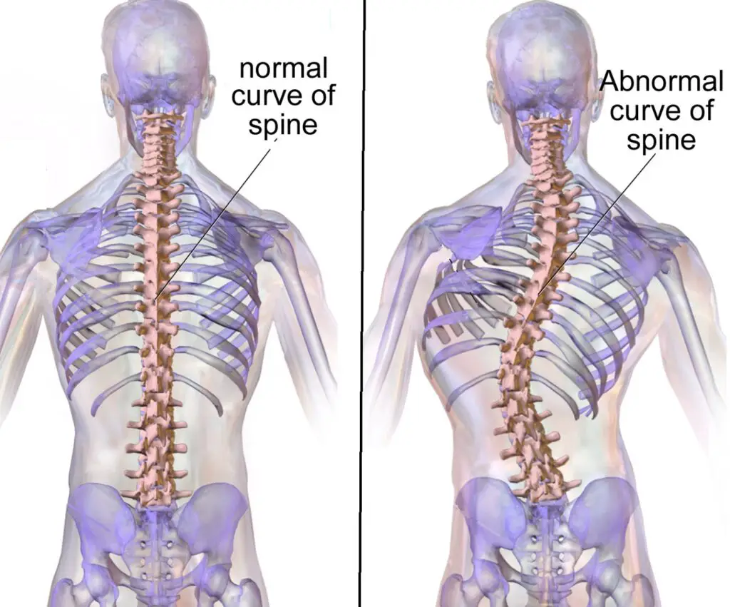 scoliosis