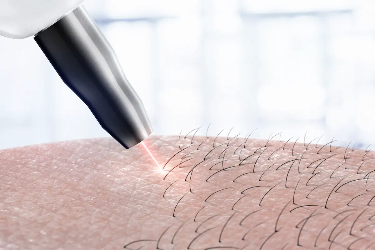 Does Insurance Cover Laser Hair Removal