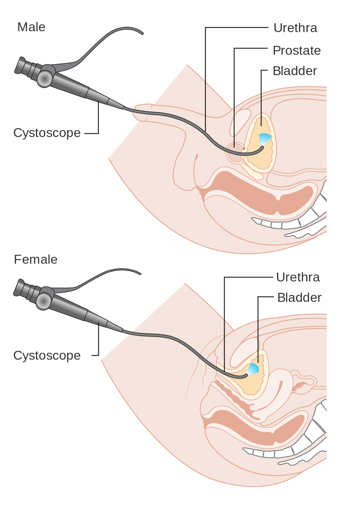 Cystoscopy