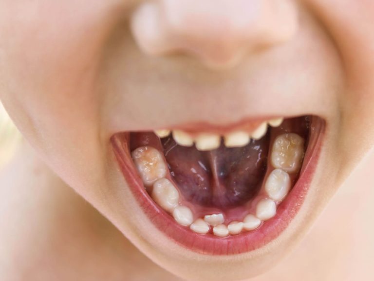 How Much Does TongueTie Surgery Cost with Insurance? Frenectomy Cost