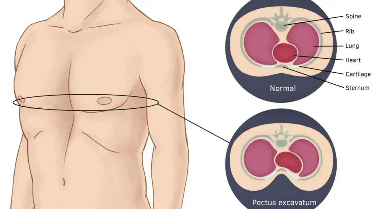 Pectus Excavatum