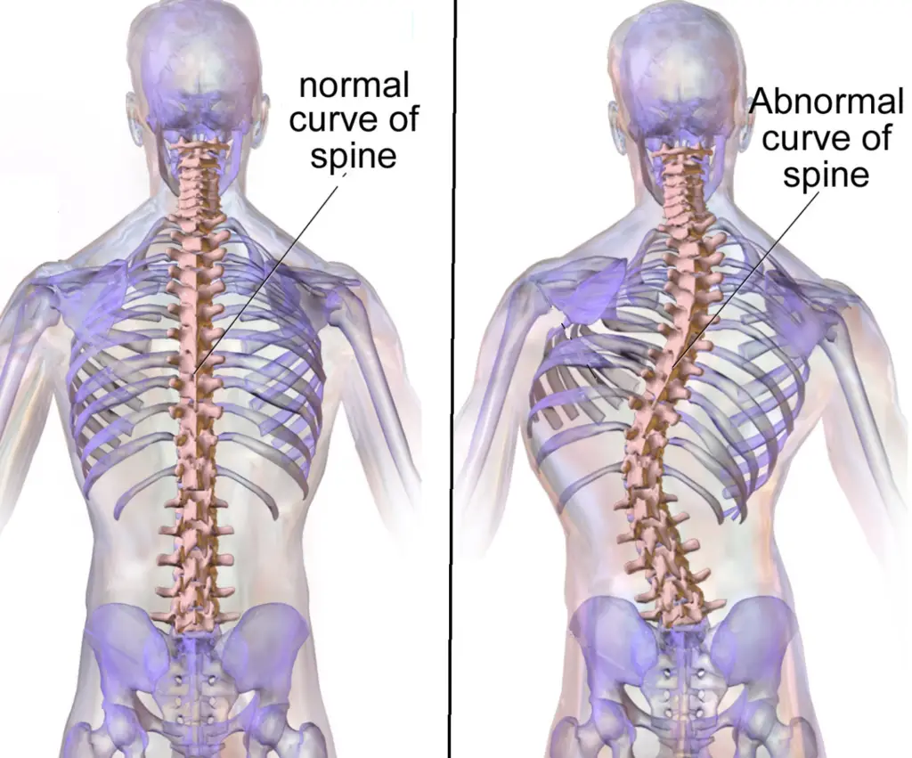 scoliosis