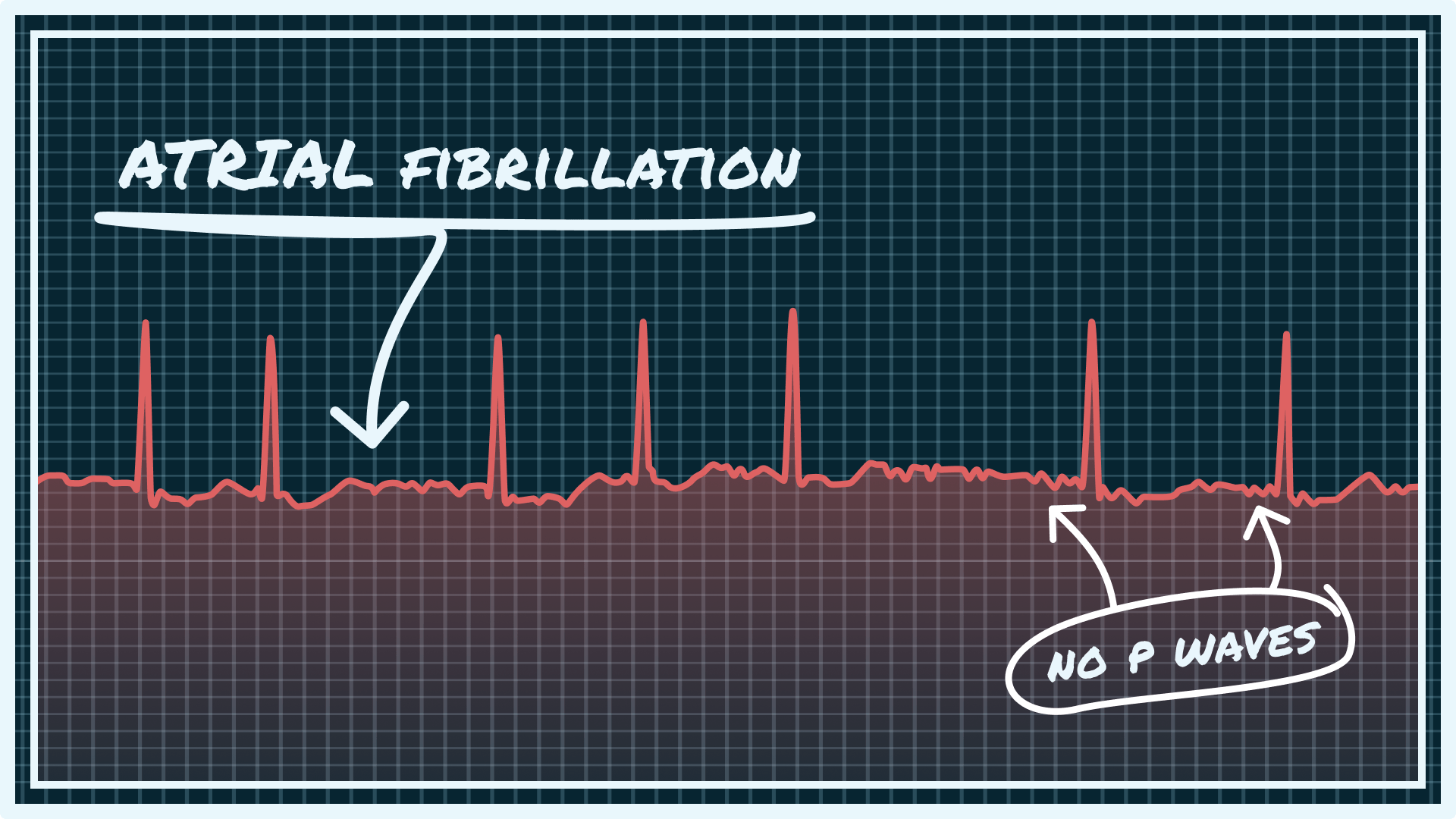 atrial fibrillation (A-fib)